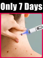 2026NEW blue light pen solve warts, hot sale wart care tools